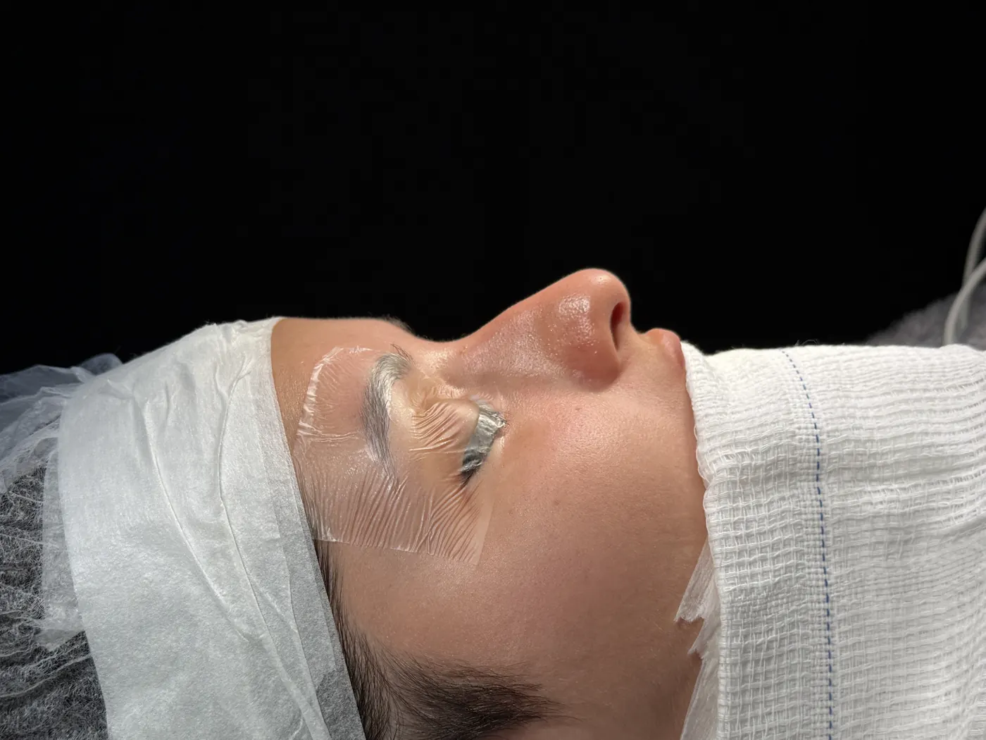 Perfil do nariz antes da rinoplastia ultrassônica — caso 01