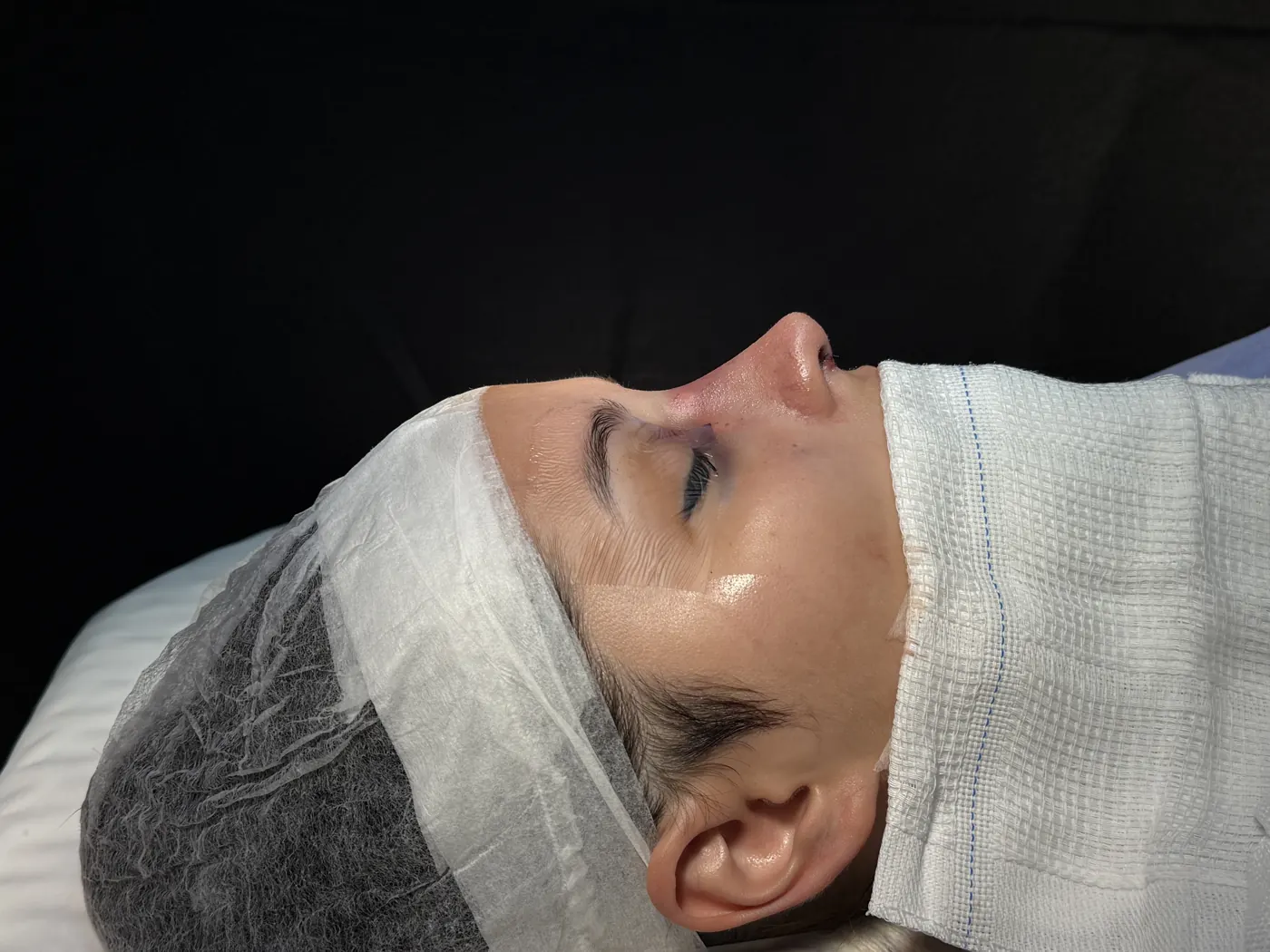 Perfil do nariz ao final da rinoplastia ultrassônica — caso 01