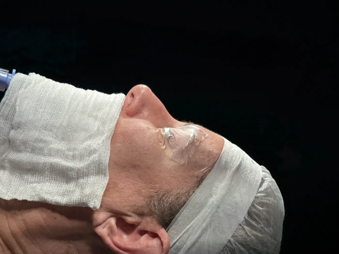 Perfil do nariz antes da rinoplastia ultrassônica — caso 02
