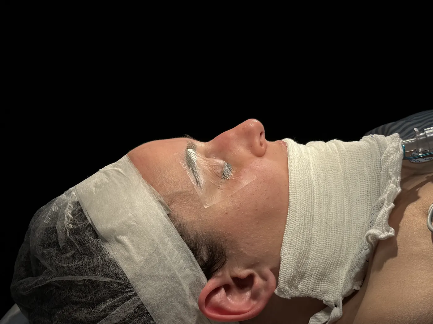 Perfil do nariz antes da rinoplastia ultrassônica — caso 03