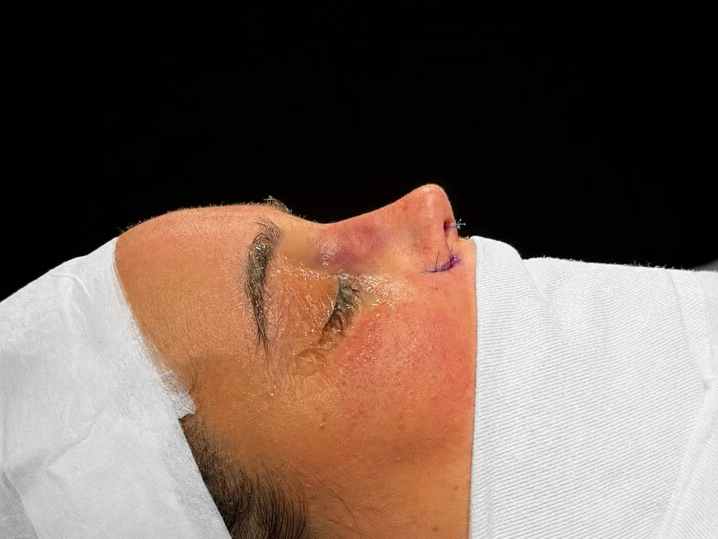 Perfil do nariz ao final da rinoplastia ultrassônica — caso 03