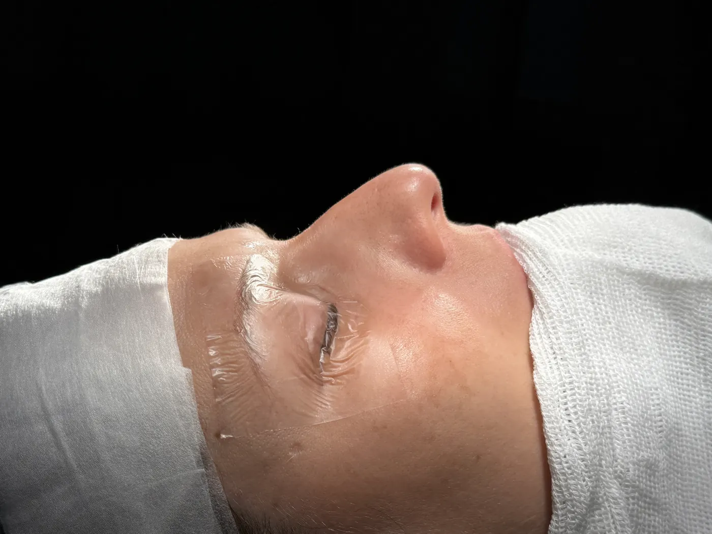 Perfil do nariz antes da rinoplastia ultrassônica — caso 04