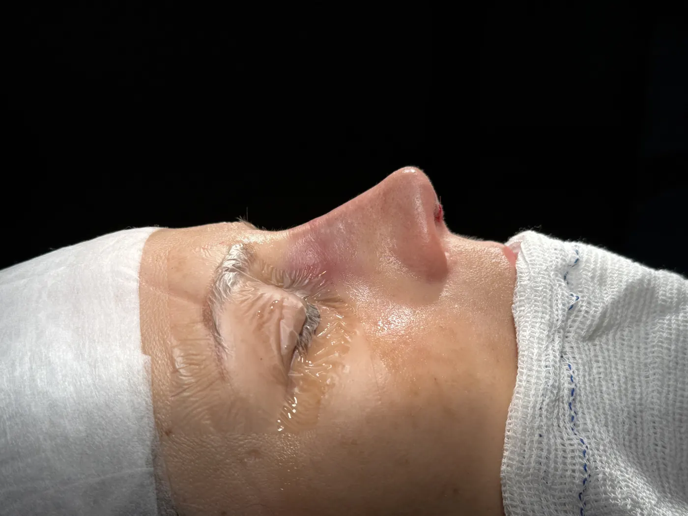 Perfil do nariz ao final da rinoplastia ultrassônica — caso 04