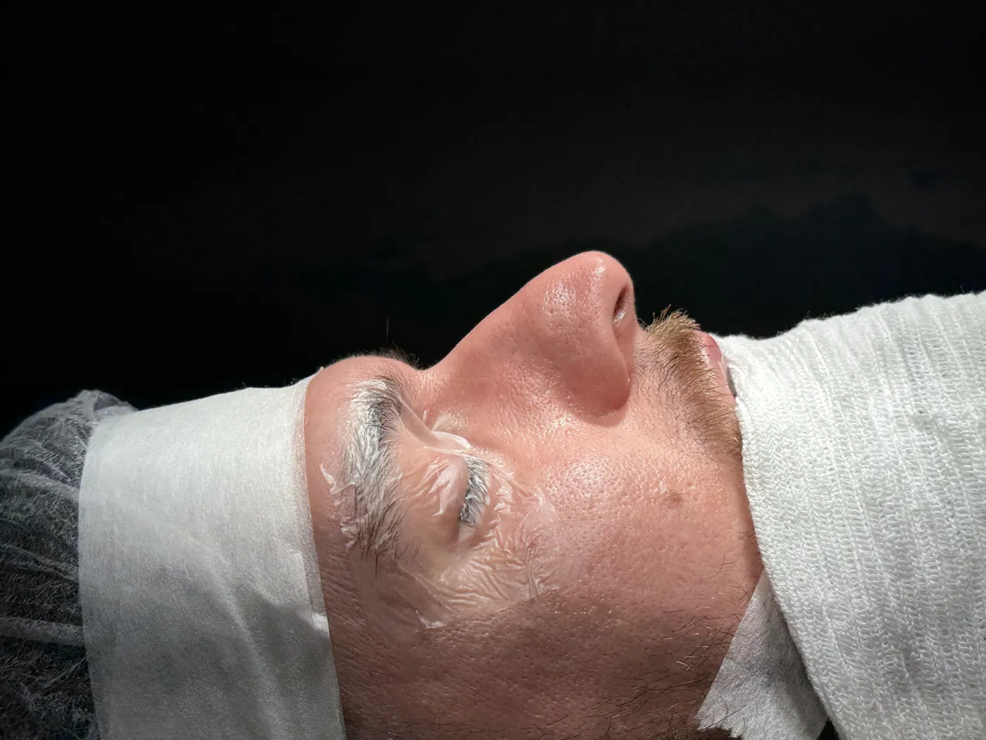 Perfil do nariz antes da rinoplastia ultrassônica — caso 05