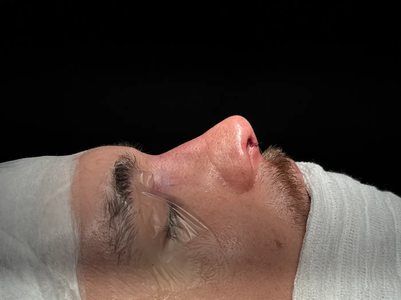 Perfil do nariz ao final da rinoplastia ultrassônica — caso 05