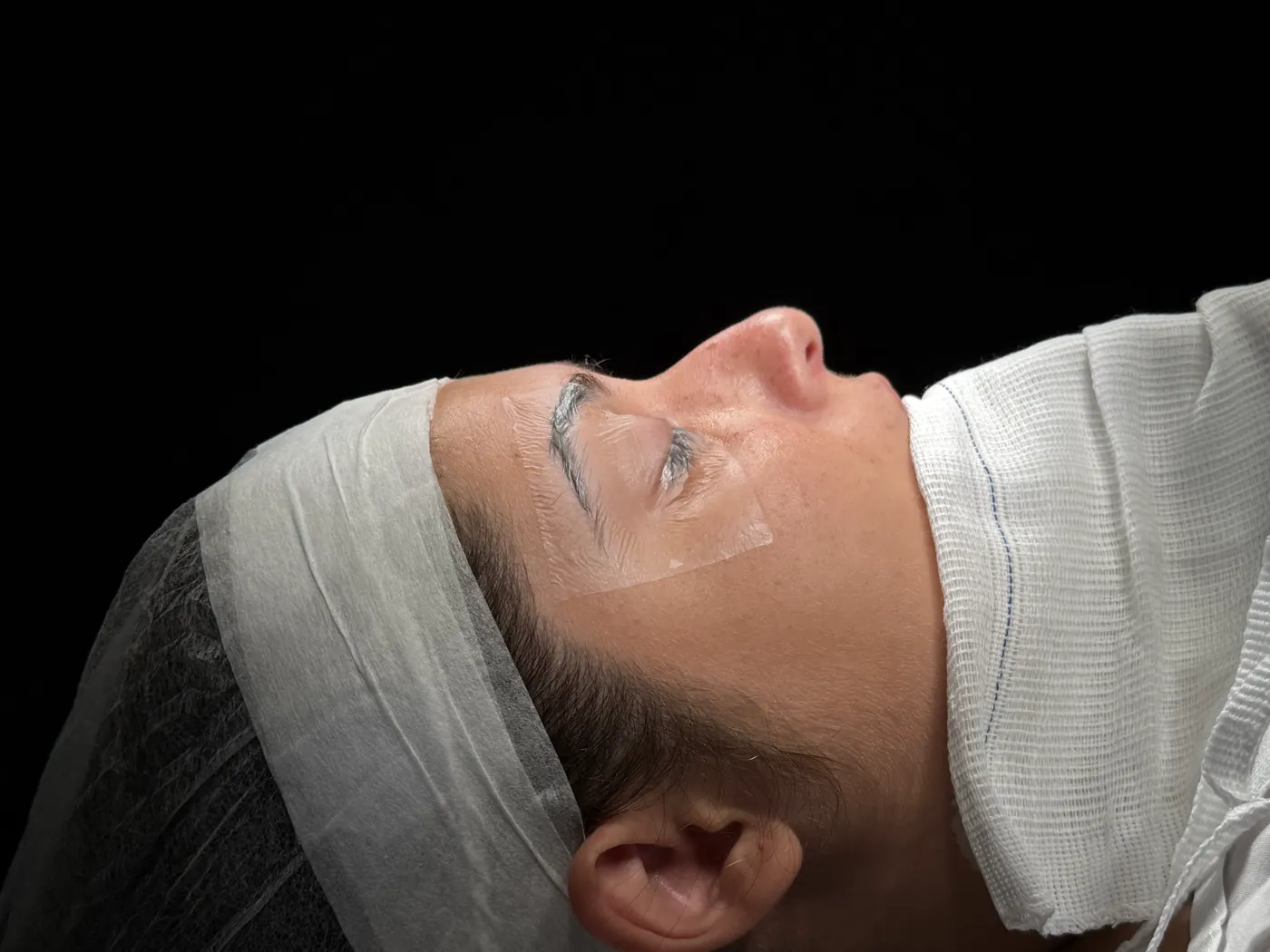 Perfil do nariz antes da rinoplastia ultrassônica — caso 06