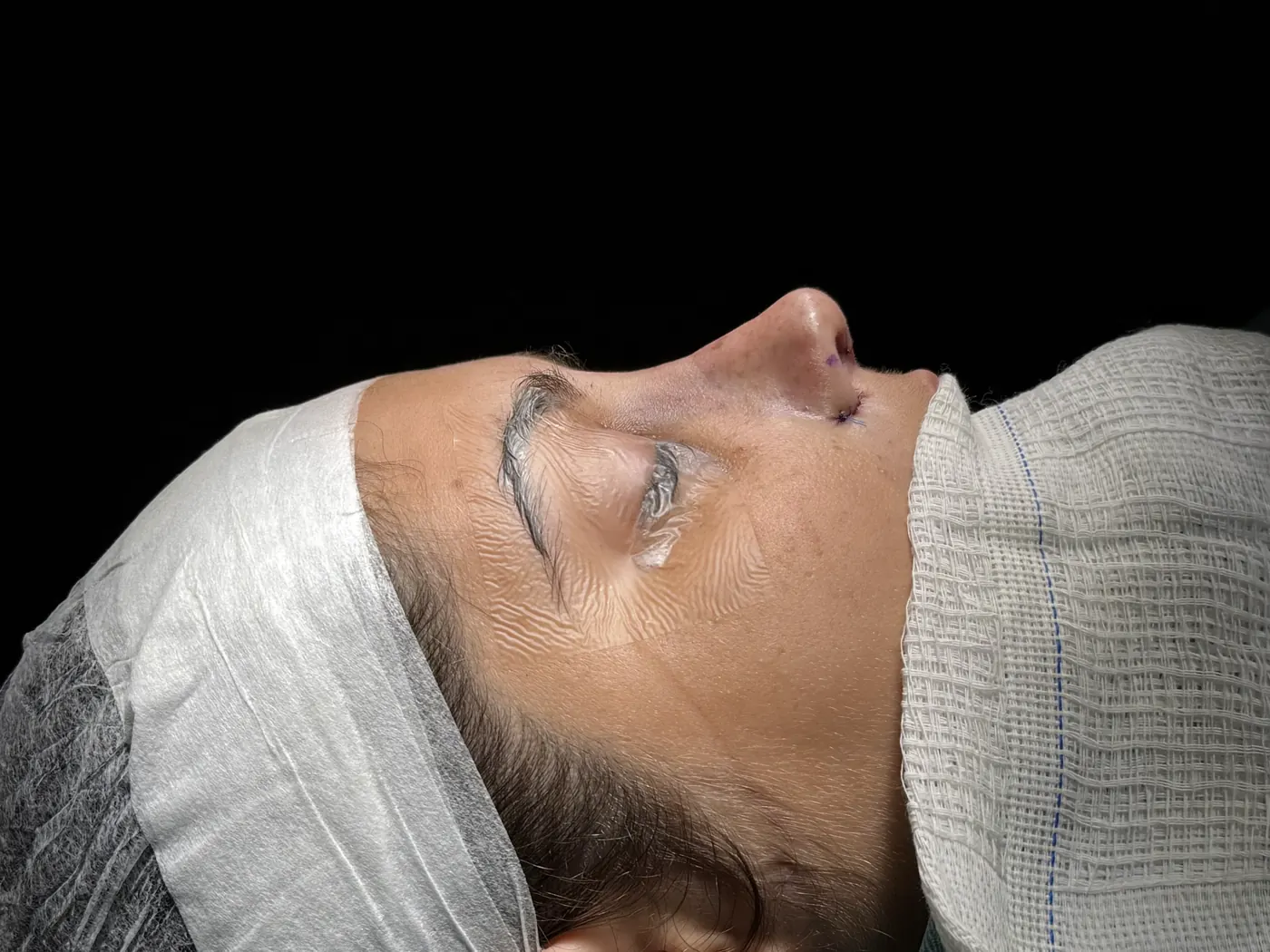 Perfil do nariz ao final da rinoplastia ultrassônica — caso 06