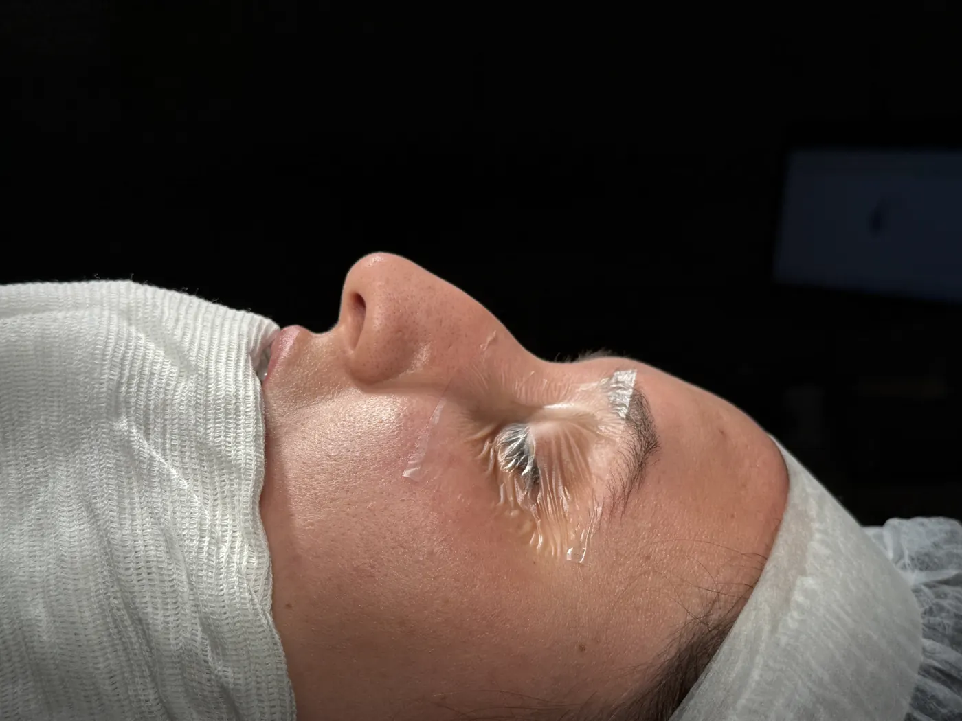 Perfil do nariz antes da rinoplastia ultrassônica — caso 07