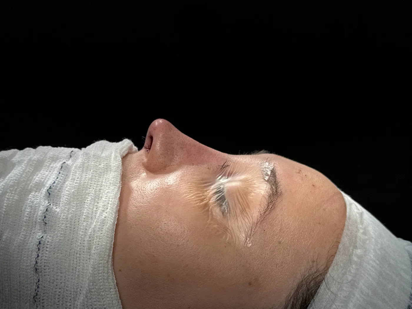 Perfil do nariz ao final da rinoplastia ultrassônica — caso 07