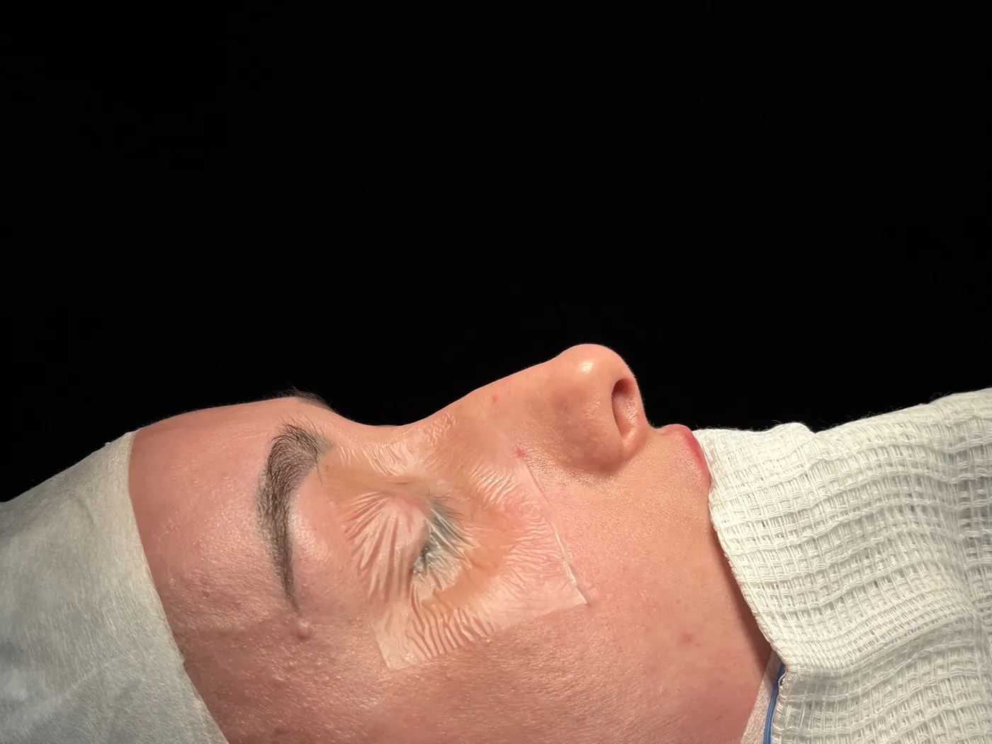 Perfil do nariz antes da rinoplastia ultrassônica — caso 08