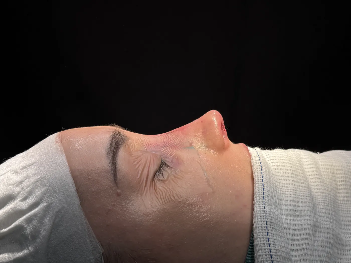 Perfil do nariz ao final da rinoplastia ultrassônica — caso 08